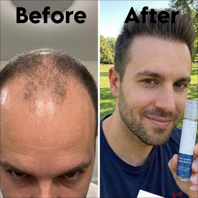 Advanced Hair Growth Serum - Skinism