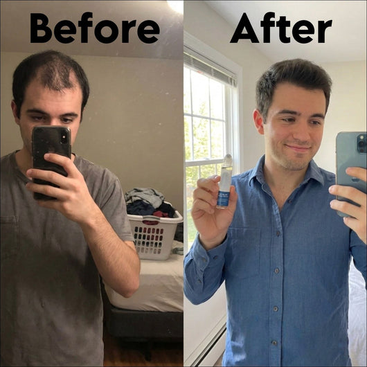Advanced Hair Growth Serum - Skinism